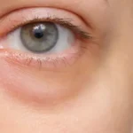 puffiness under the eyes
