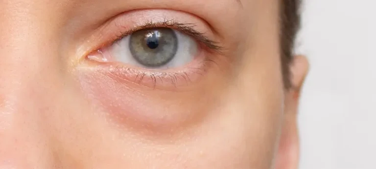 puffiness under the eyes